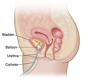 Cross section of female pelvis showing foley catheter inserted into bladder.